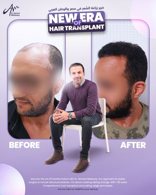 من هو أفضل دكتور زراعة شعر في مصر2025؟